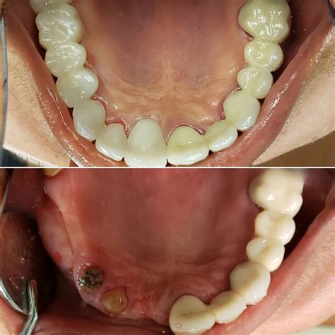 Dental Implants Kent .